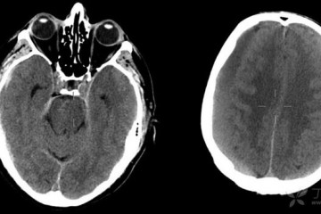 Arsenal Medical 启动 NeoCast™ EMBO-02 研究，评估慢性硬膜下血肿的治疗效果